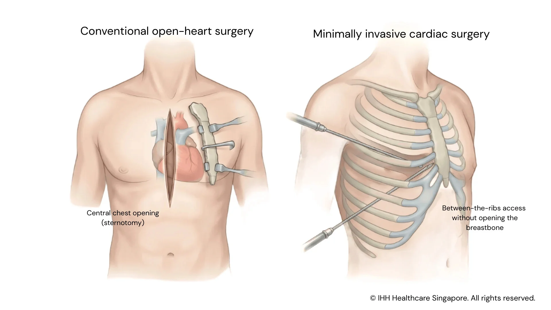 Visual comparison between traditional open-heart surgery and keyhole MICS surgery
